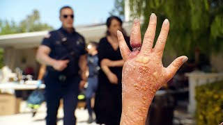 A ring gets stuck on a womans finger due to an allergic reaction [upl. by Flossi]