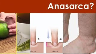 ANASARCA Clinical Treatment Approach  MEDICINE [upl. by Olag]