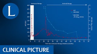 Hepatitis B reactivation after chemoimmunotherapy screen before treatment [upl. by Oinigih]