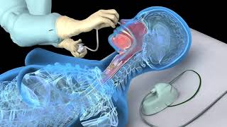 Nasotracheal suctioning NTS  3D animation [upl. by Akerdnahs403]