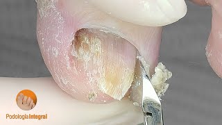 Toenail cleaning with smooth finish for the patients comfort and prevent detachments due to hooking [upl. by Novaelc467]