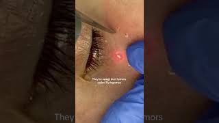 Syringoma Removal shorts shortvideo [upl. by Valerian]