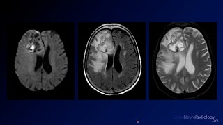 Neuroradiology Board Review  Brain Tumors  Case 1 [upl. by La]