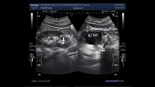 Ultrasound Video showing renal Angiomyolipoma with stones at PUJ [upl. by Anselma]