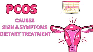 Polycystic Ovary Syndrome  PCOS  Causes  Sign  Symptoms amp Dietary Treatment [upl. by Giesser]