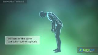 Kyphosis Symptoms [upl. by Aissatsana]