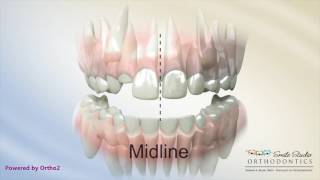 Midline Shift Due to Blocked Out Teeth  Orthodontic Treatment [upl. by Nappy740]