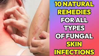 10 Natural Remedies for Fungal Infection on Skin Tinea Ringworm Yeast infection Private parts [upl. by Eldred79]