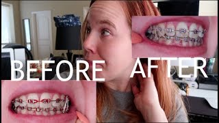 Braces Vlog 10 What to expect from your braces [upl. by Schweitzer]