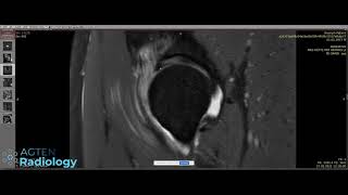 Hip Case from Saturday Evening MSK Radiology LIVE  in 4K 219 ratio [upl. by Treblih]