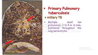 Miliary Tuberculosis [upl. by Yllor]