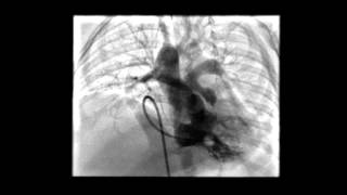 Tetralogy of Fallot RV Angiogram [upl. by Ttenna]