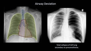 How to Interpret a Chest XRay Lesson 4  Airways Bones and Soft Tissues [upl. by Selij]