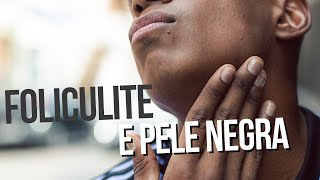 FOLICULITE E PELE NEGRA [upl. by Yme]