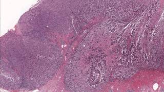 Colon Adenocarcinoma  Microscopic Diagnosis and Molecular Testing [upl. by Kenta287]