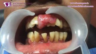 Massive Epulis Removal Treatment  Dental Videos showing Oral Surgery [upl. by Nallaf]