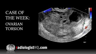 Case of the Week Ovarian Torsion Ultrasound [upl. by Leuname]