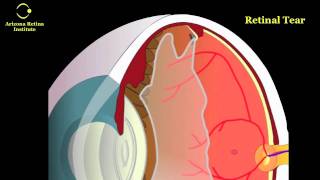 Eye Floaters Retinal Tears and Retinal Detachments [upl. by Amalia]