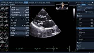 Standardisierte Echokardiographie  Normalbefund [upl. by Adnomal690]