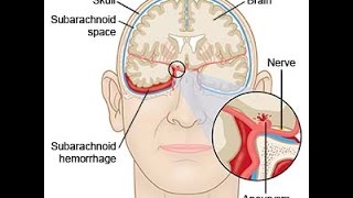 Subarachnoid Hemorrhage [upl. by Aniral]