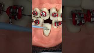 🔥Subiendo dientes 🦷 con brackets 😬 metálicos🔥 [upl. by Deckert]