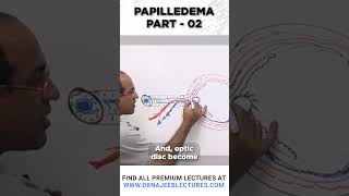 Papilledema Part 02 drnajeeb drnajeeblectures youtubeshorts [upl. by Caesaria]