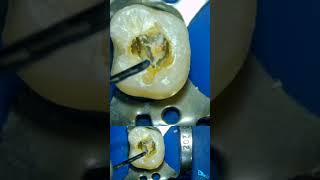 guttapercha Removal Demo using D RETREATMENT files [upl. by Nav]