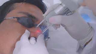 Trujillo Peru Laser co2 Fraccionado DEKA para Hiperplasia Sebácea  Estetica [upl. by Rorie]