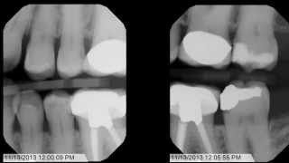 Tips and Tricks for Bitewing XRays [upl. by Demmahum]