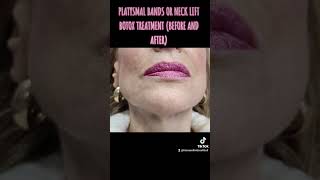 PLATYSMAL BANDS OR NECK LIFT BOTOX TREATMENT BEFORE AND AFTER [upl. by Nev712]