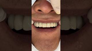 전체임플란트 미국시애틀에서 2번 한국오셔서 치료마무리 dental dentist modernimplant [upl. by Aniluap]