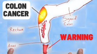 4 Warning Signs of Colon Cancer You Should NEVER Ignore [upl. by Holna]