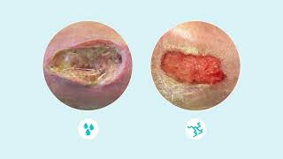 How to assess wound exudate [upl. by Airamasor]