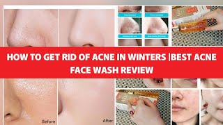 100 honest Review about the Alite facewashbest products to remove acne and blackheadsblackheads [upl. by Barthold]