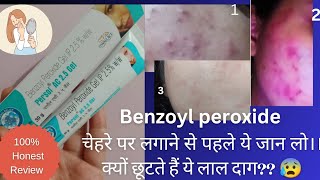 benzoyl peroxide gel 25  benzoyl peroxide gel Persol AC 25 review gel acne skincare [upl. by O'Donoghue]