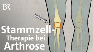 StammzellTherapie bei Arthrose Neue Behandlungsmethoden bei Knieschmerzen  Gut zu wissen  BR [upl. by Rabelais751]