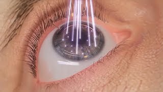 How Laser Eye Surgery Lasik is Performed  3D Animation UrduHindi [upl. by Vernor885]