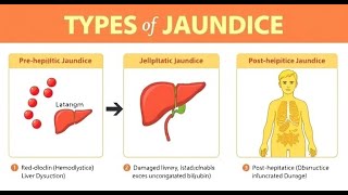 Jaundice  types causes symptoms newborn jaundice diet treatment [upl. by Reinwald]