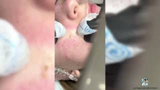 Ultimate Pimple Popping 2024 Amazing Blackhead Removals [upl. by Patnode]