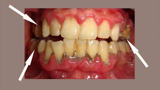 Periodontitis Treatment  Miracle Cure of Gum Disease and Periodontitis [upl. by Montfort78]