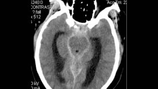 CT Head Subarachnoid Hemorrhage DISCUSSION by Radiologist [upl. by Leod690]