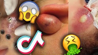 Pimple Blackheads Cysts Popping Videos TikTok Compilation Part 8 [upl. by Anitsim]