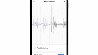 Aortic Stenosis Phonocardiogram  EkoCLINIC App [upl. by Bord]