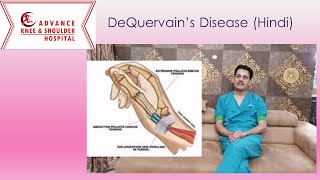 DeQuervains Disease का इलाज़ Hindi India [upl. by Aisauqal]