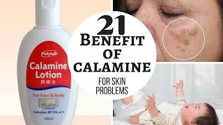 CALAMINE lotion  Lacto calamine lotion uses in detail side effects [upl. by Kenelm956]