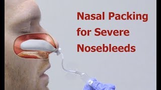 Nasal Packing for Severe Nosebleeds [upl. by Hun]