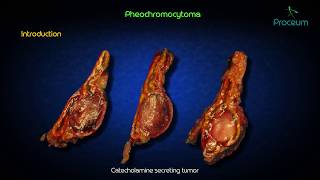 Pheochromocytoma usmle step 1  Etiology  Pathogenesis  clinical features  treatment [upl. by Asilehs452]