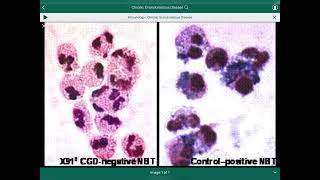 Chronic Granulomatous Disease Cases Scenario  سيناريو حالات مرض الحبيبات المزمن [upl. by Soilissav]