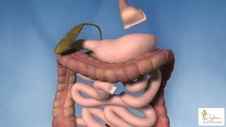 ROUX EN Y GASTRIC BYPASS [upl. by Ecirtnuahs]