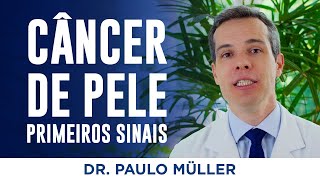 Câncer de Pele Primeiros Sinais – Dr Paulo Müller Dermatologista [upl. by Crim439]